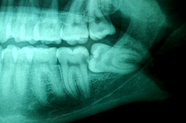 When to Remove Wisdom Teeth Growing in and Caring Tips After Surgery